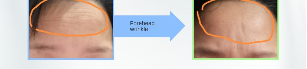 Free Shipping Oxygen Release Ring Shrink Pores Firm and Bright Lock Water Fading Wrinkle Smooth Elasticity Weaken Acne