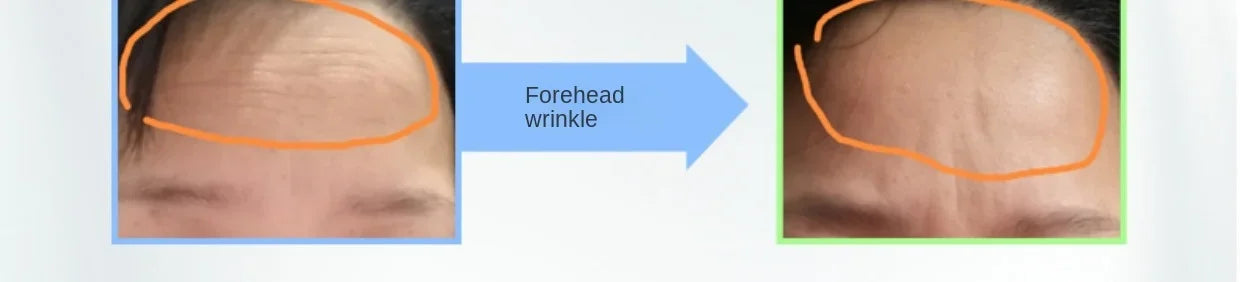 Free Shipping Oxygen Release Ring Shrink Pores Firm and Bright Lock Water Fading Wrinkle Smooth Elasticity Weaken Acne